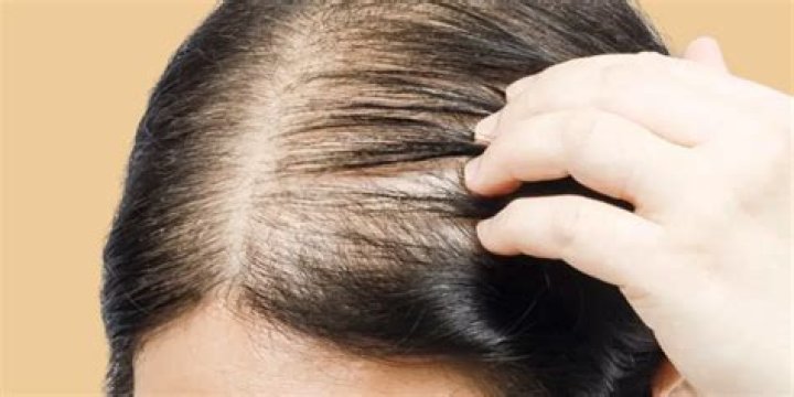 absence of hair from areas where it normally grows