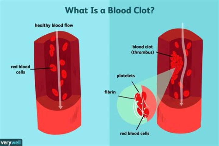 what do blood clot mean in jamaican